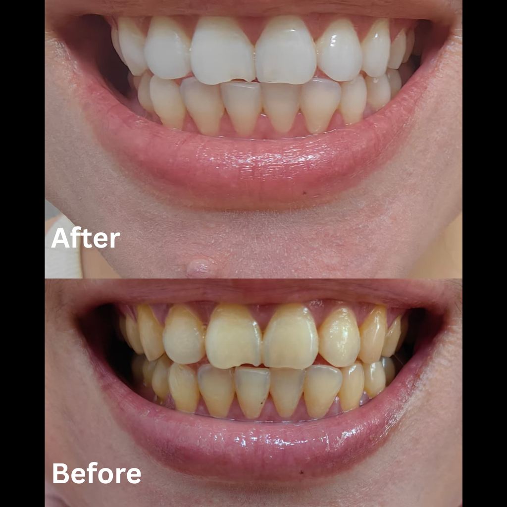 Premium Aiveen Whitening Kit
