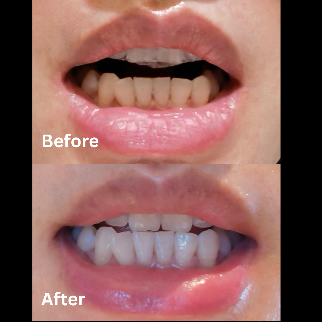 Premium Aiveen Whitening Kit