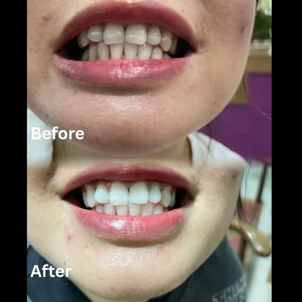 Premium Aiveen Whitening Kit
