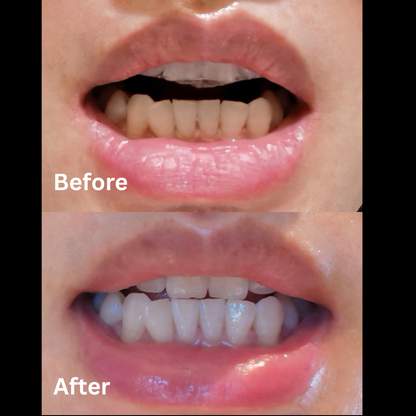 Premium Aiveen Whitening Kit